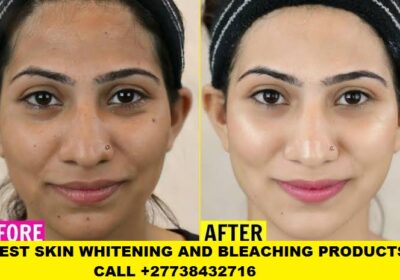 Skin-Bleaching-and-whitening-in-Senagal-27738432716